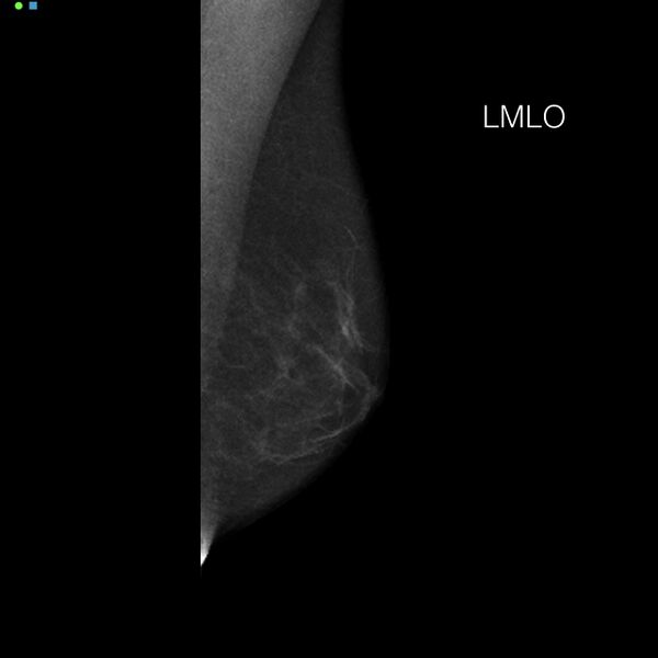File:Normal breast mammography (tomosynthesis) and ultrasound (Radiopaedia 65325-74355 D 1).jpeg