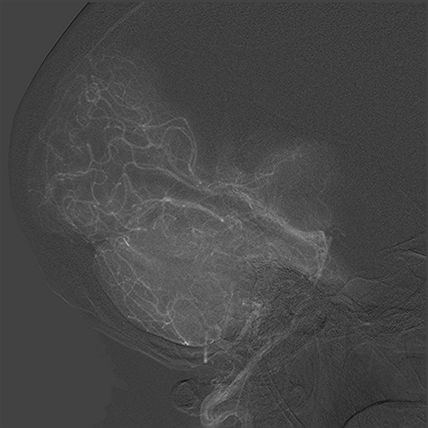 File:Normal cerebral angiogram (four vessel DSA) (Radiopaedia 41708-44649 L 13).png