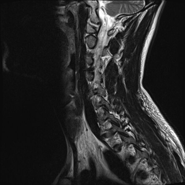 File:Normal cervical spine MRI (Radiopaedia 38418-40496 Sagittal T2 4).jpg
