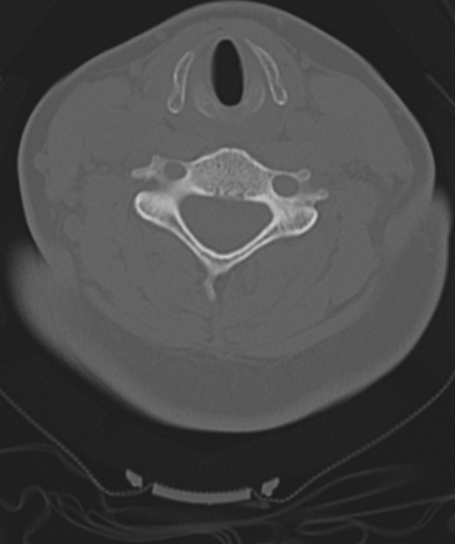 File:Normal cervical spine MRI (including Dixon) (Radiopaedia 42762-45926 Axial bone window 34).png
