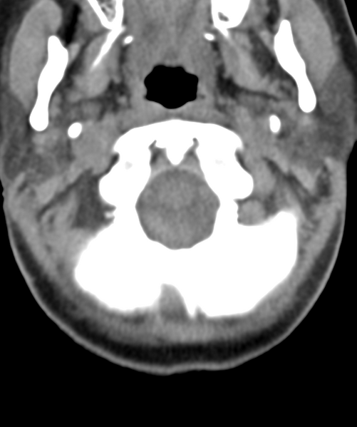 File:Normal cervical spine MRI (including Dixon) (Radiopaedia 42762-45926 Axial non-contrast 9).png