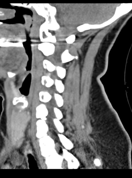 File:Normal cervical spine MRI (including Dixon) (Radiopaedia 42762-45926 C 38).png