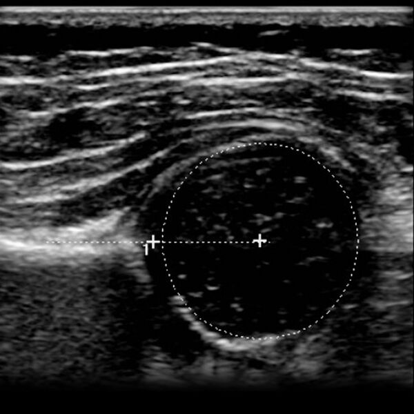 File:Normal hip ultrasound - infant (Radiopaedia 2718-6410 A 1).jpg