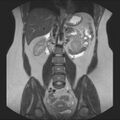Normal liver MRI with Gadolinium (Radiopaedia 58913-66163 Coronal T2 24).jpg