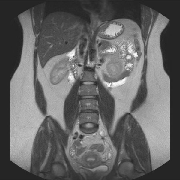 File:Normal liver MRI with Gadolinium (Radiopaedia 58913-66163 Coronal T2 24).jpg