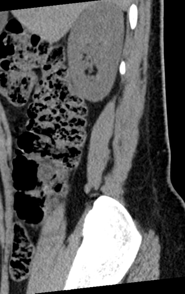 File:Normal lumbar spine CT (Radiopaedia 46533-50986 C 97).png