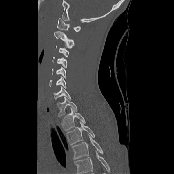 File:Normal trauma spine imaging (age 16) (Radiopaedia 45335-49358 Sagittal bone window 13).jpg