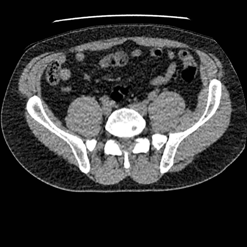 Obstructing ureteric calculus and ureteric anatomy (Radiopaedia 62730-71042 Axial non-contrast 106).jpg