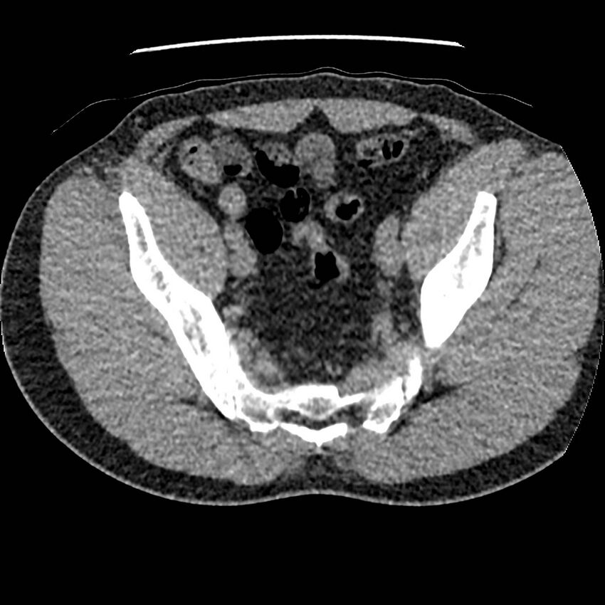 Obstructing ureteric calculus and ureteric anatomy (Radiopaedia 62730-71042 Axial non-contrast 136).jpg