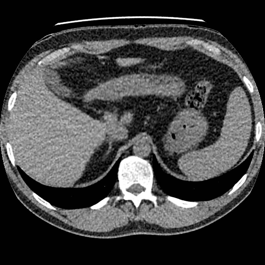 Obstructing ureteric calculus and ureteric anatomy (Radiopaedia 62730-71042 Axial non-contrast 2).jpg