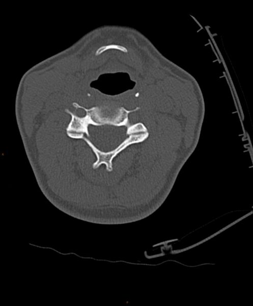 File:Occipital condyle fracture (Radiopaedia 61165-69056 D 16).jpg