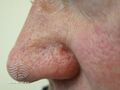 Sebaceous carcinoma (DermNet NZ lesions-sebaceous-ca-2).jpg
