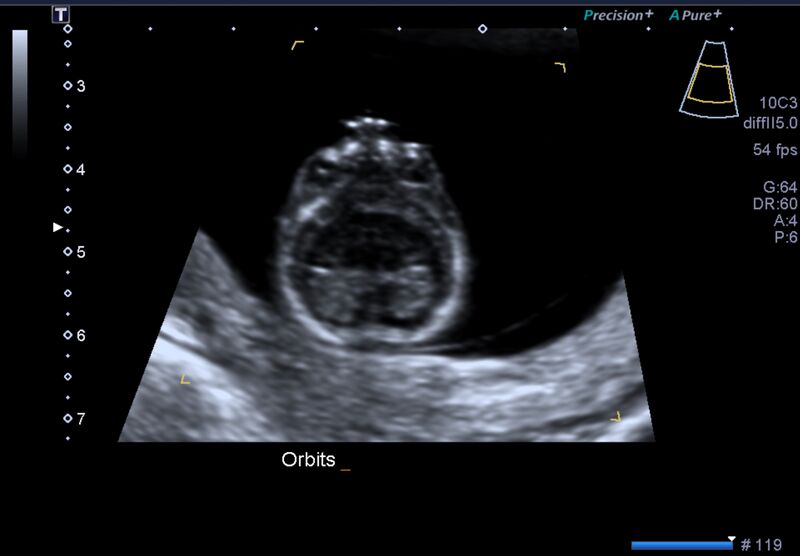 File:1st trimester nuchal-morphology ultrasound (Radiopaedia 44706-48477 General anatomy and NT 8).jpg