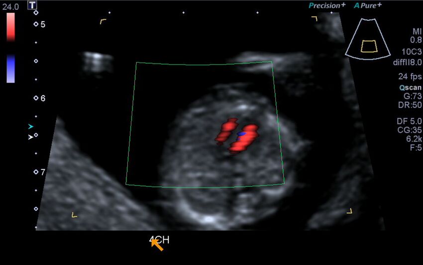 1st trimester nuchal-morphology ultrasound (Radiopaedia 44706-48477 Heart views cine with colour 83).jpg
