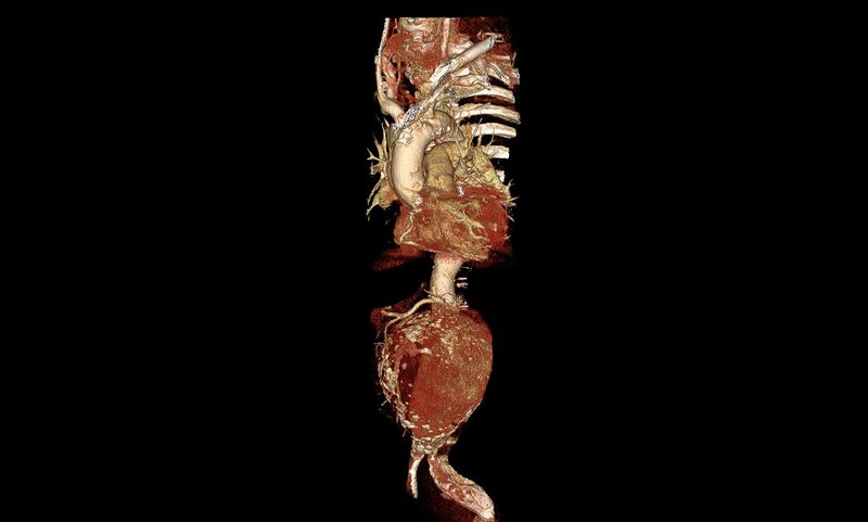 File:Abdominal aortic aneurysm- extremely large, ruptured (Radiopaedia 19882-19921 3D 3).jpg