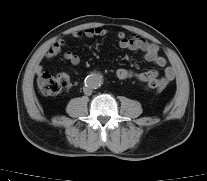 File:Abdominal aortic aneurysm (Radiopaedia 22421-22458 non-contrast 32).jpg