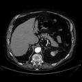 Abdominal aortic aneurysm (Radiopaedia 25855-26001 Axial C+ arterial phase 37).jpg