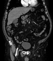 Abdominal aortic aneurysm (Radiopaedia 25855-26001 Coronal C+ arterial phase 13).jpg