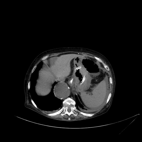 File:Abdominal aortic aneurysm - impending rupture (Radiopaedia 19233-19246 Axial non-contrast 25).jpg