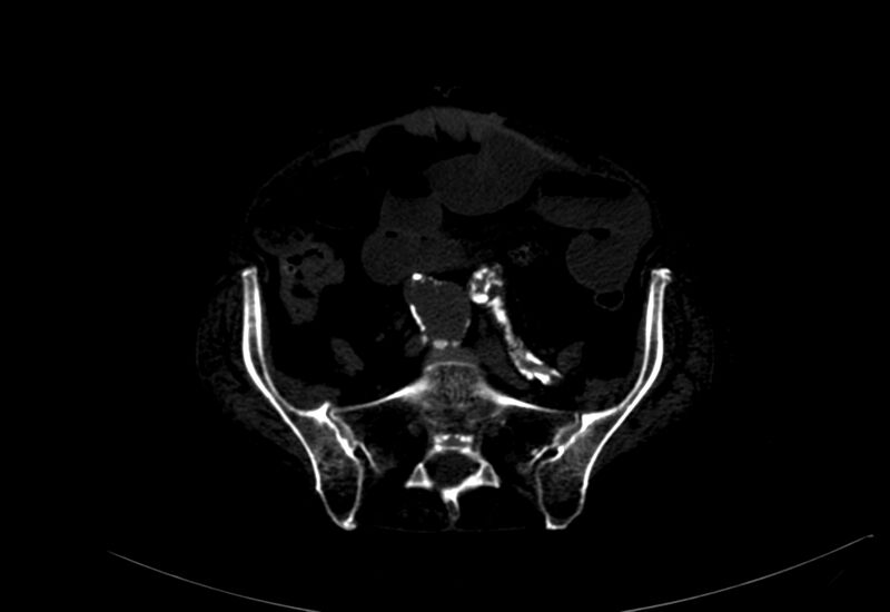 File:Abdominal aortic aneurysm - impending rupture (Radiopaedia 19233-19246 B 41).jpg