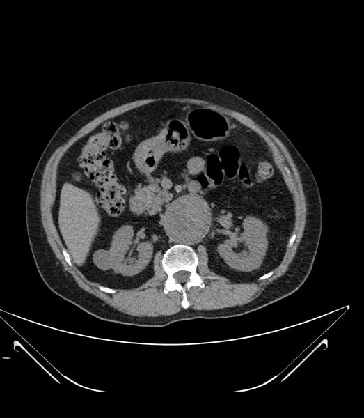 File:Abdominal aortic aneurysm with thrombus fissuration (Radiopaedia 46218-50618 Axial non-contrast 19).jpg