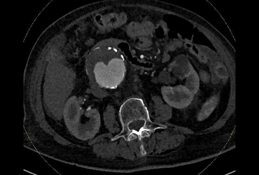 Abdominal aortic aneurysm with thrombus fissuration (Radiopaedia 73192-83919 Axial C+ arterial phase 80).jpg