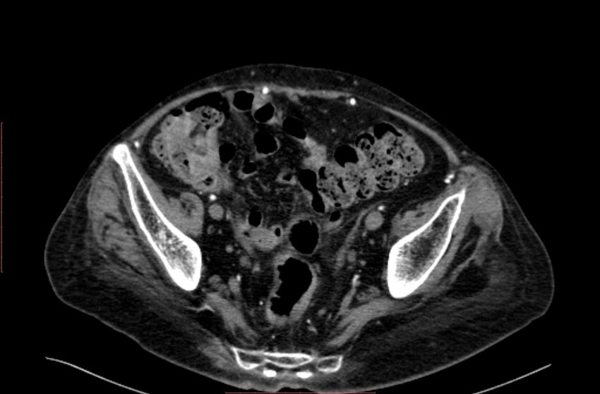 Abdominal aortic interposition tube graft and aneurysm thrombosis (Radiopaedia 71438-81857 Axial C+ arterial phase 192).jpg