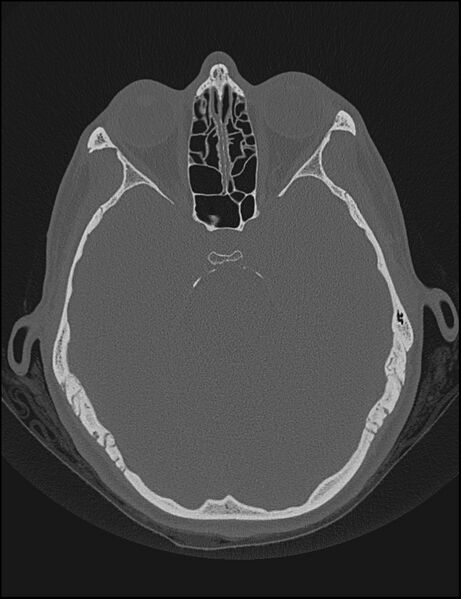 File:Aberrant right internal carotid artery (Radiopaedia 65191-74198 Axial non-contrast 65).jpg