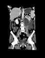 Accessory right inferior hepatic vein (Radiopaedia 33050-34067 Coronal C+ portal venous phase 5).jpg