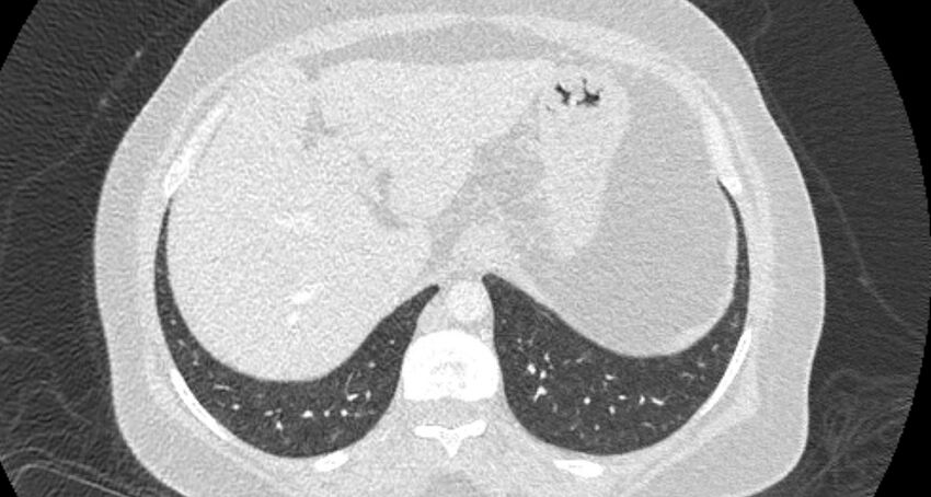 Accessory right inferior hepatic vein (Radiopaedia 65245-74259 Axial lung window 68).jpg