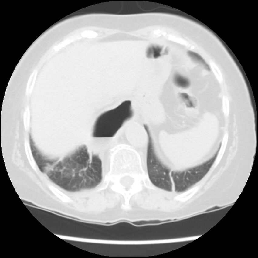 Achalasia (Radiopaedia 44094-47649 Axial lung window 49).jpg