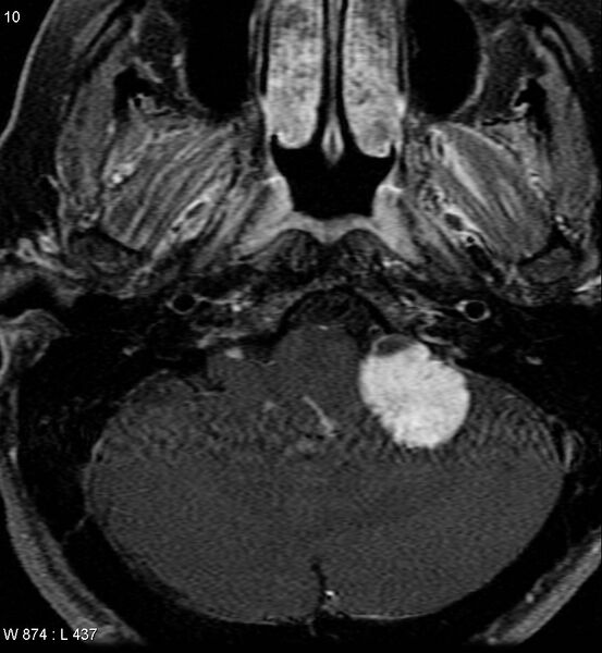 File:Acoustic schwannoma (large with cystic change) (Radiopaedia 5369-7130 Axial T1 C+ fat sat 8).jpg