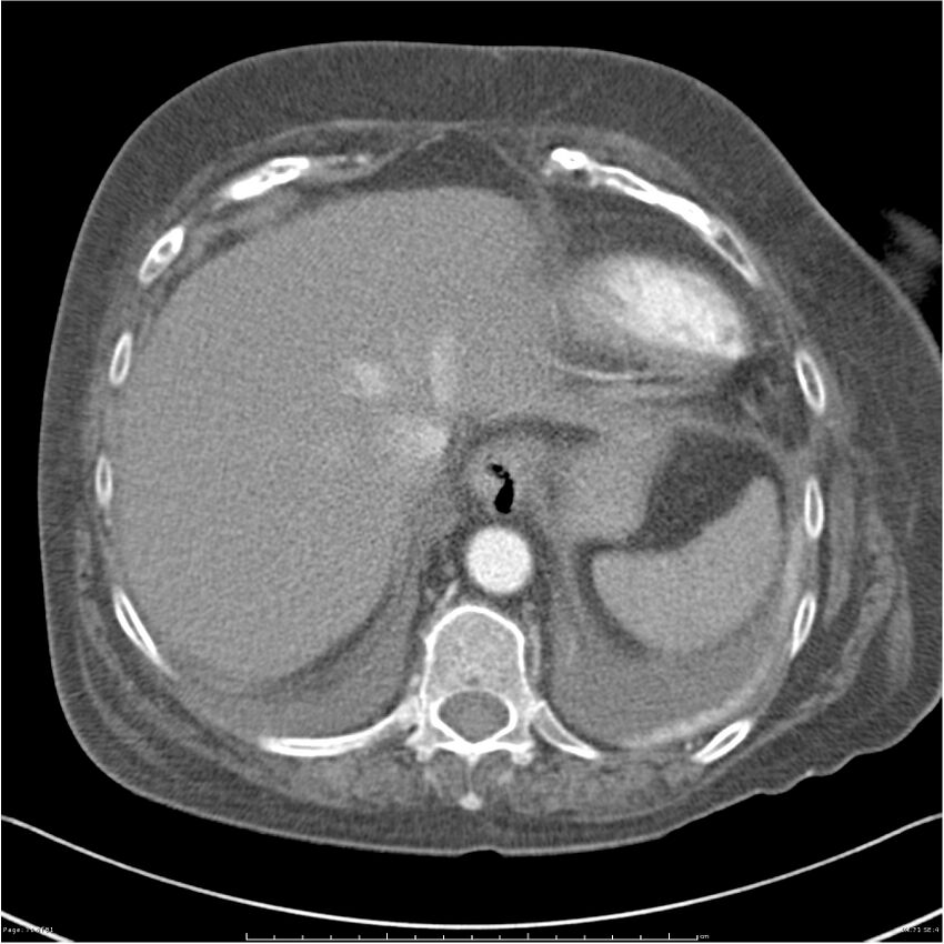 Acute-on-chronic pulmonary emboli (Radiopaedia 27925-28169 C+ CTPA 71).jpg