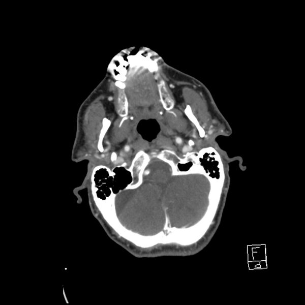 File:Acute ICA ischemic penumbra due to high-grade CCA stenosis (CT perfusion) (Radiopaedia 72038-82530 Axial C+ arterial phase 24).jpg
