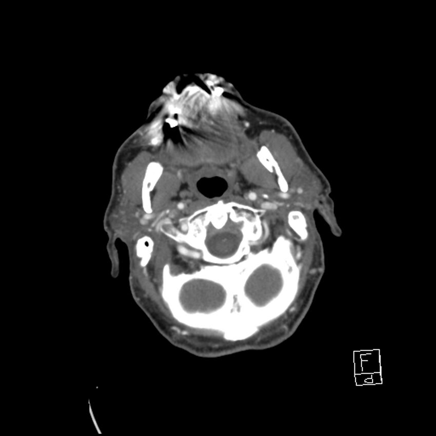 Acute ICA ischemic penumbra due to high-grade CCA stenosis (CT perfusion) (Radiopaedia 72038-82530 Axial C+ arterial phase 28).jpg