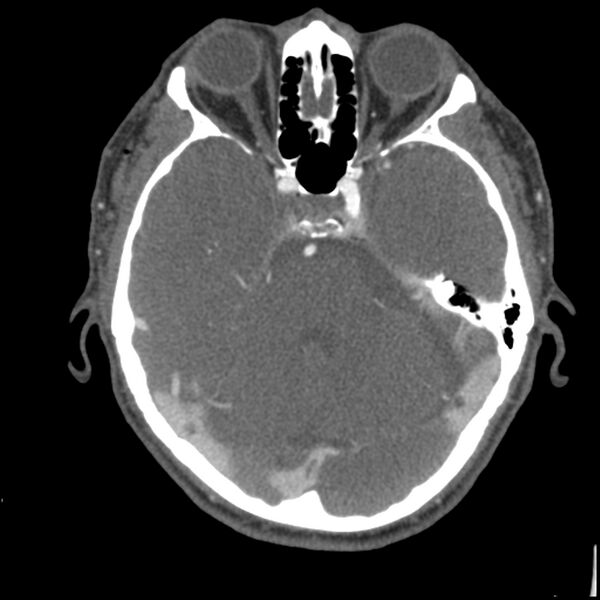 File:Acute P1 occlusion with PCA ischemia penumbra (CT perfusion) (Radiopaedia 72084-82587 Axial C+ arterial thins 65).jpg