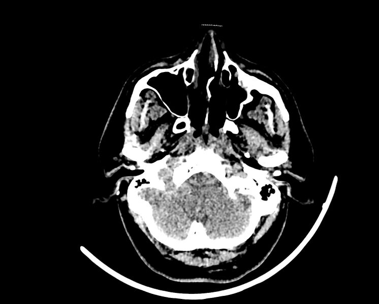 File:Acute cerebral infarct (Radiopaedia 35604-37123 Axial non-contrast 12).jpg