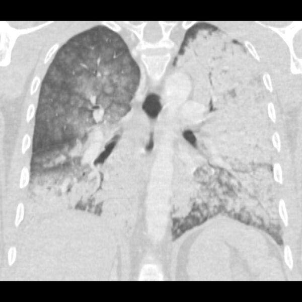 File:Acute diffuse alveolar hemorrhage (Radiopaedia 41323-44158 Coronal lung window 34).jpg