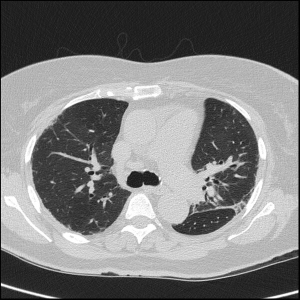 File:Acute interstitial pneumonitis (Radiopaedia 45404-49453 Axial lung window 34).jpg
