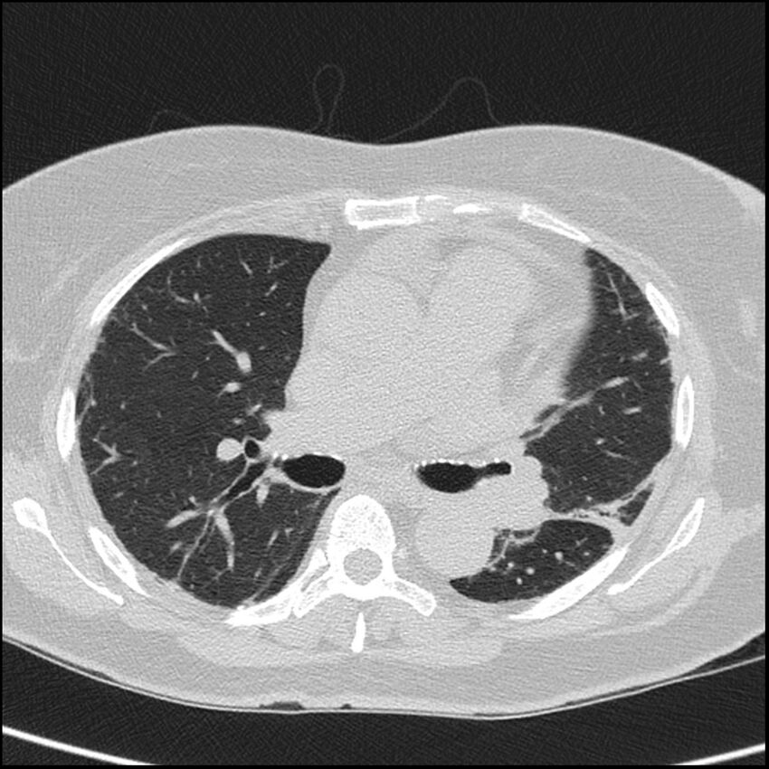 Acute interstitial pneumonitis (Radiopaedia 45404-49453 Axial lung window 39).jpg