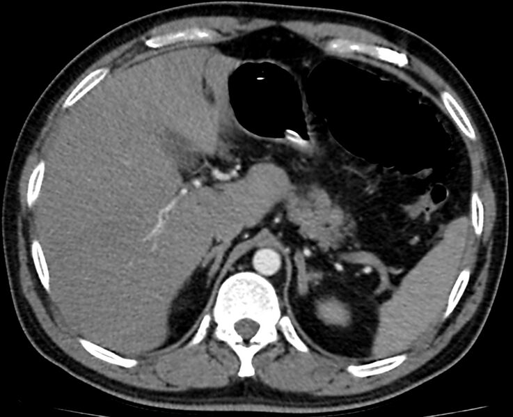 File:Acute mesenteric ischemia - superior mesenteric artery thrombosis (Radiopaedia 73947-84776 Axial C+ arterial phase 3).jpg