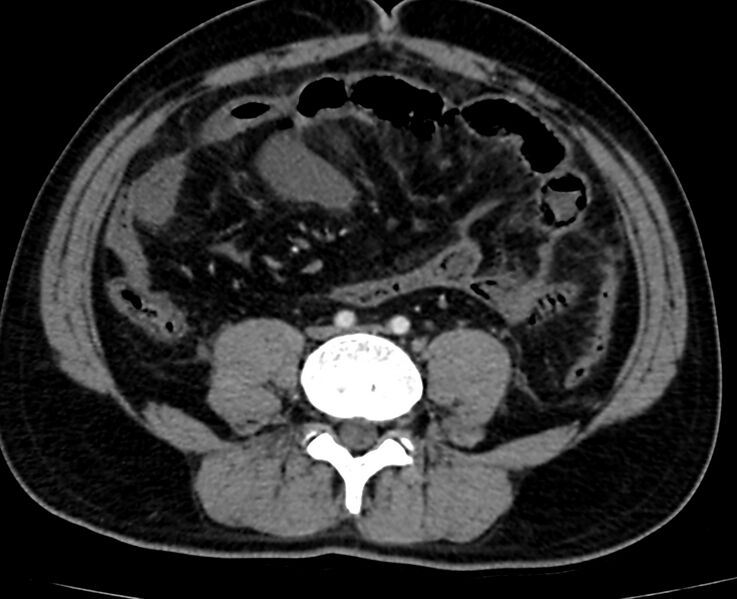 File:Acute mesenteric ischemia - superior mesenteric artery thrombosis (Radiopaedia 73947-84776 Axial C+ arterial phase 96).jpg