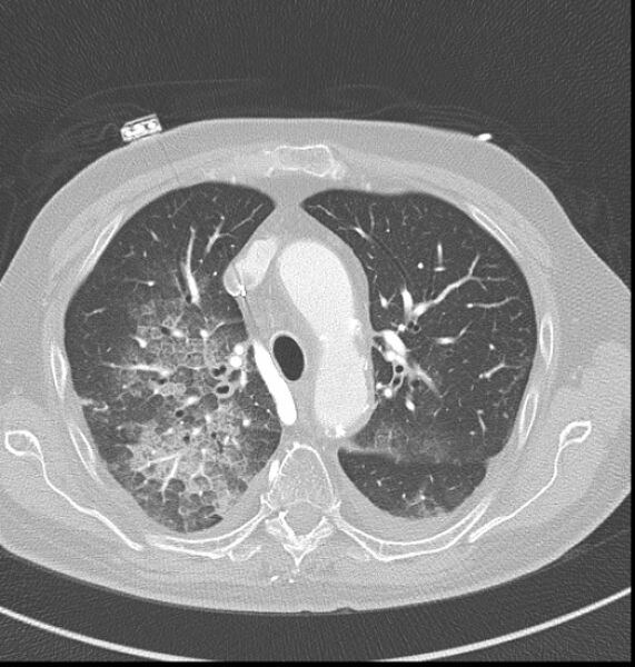 File:Acute myocardial infarction (Radiopaedia 23413-23481 lung window 9).jpg