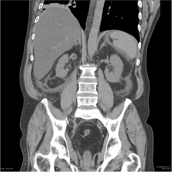 File:Acute pancreatitis (Radiopaedia 19135-19116 Coronal non-contrast 30).jpg