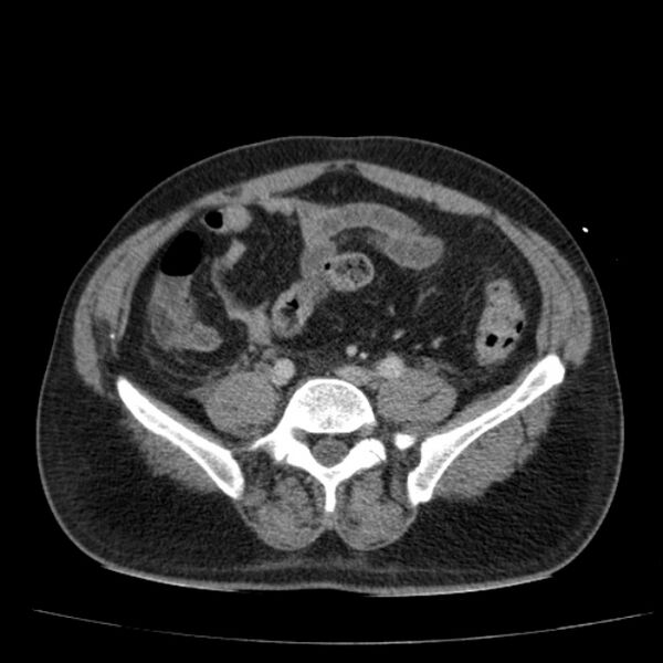 File:Acute pancreatitis (Radiopaedia 26663-26813 Axial C+ portal venous phase 60).jpg