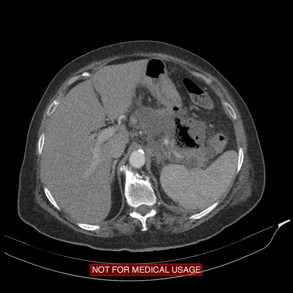 File:Acute pancreatitis with infected necrosis (Radiopaedia 26454-26585 Axial C+ arterial phase 8).jpg