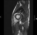 Acute perimyocarditis (Radiopaedia 48034-52833 Sagittal TRUFI CINE SHORT AXIS 107).JPG