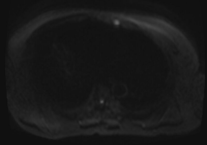 File:Acute portal vein thrombosis (Radiopaedia 73198-83925 Axial DWI 32).jpg