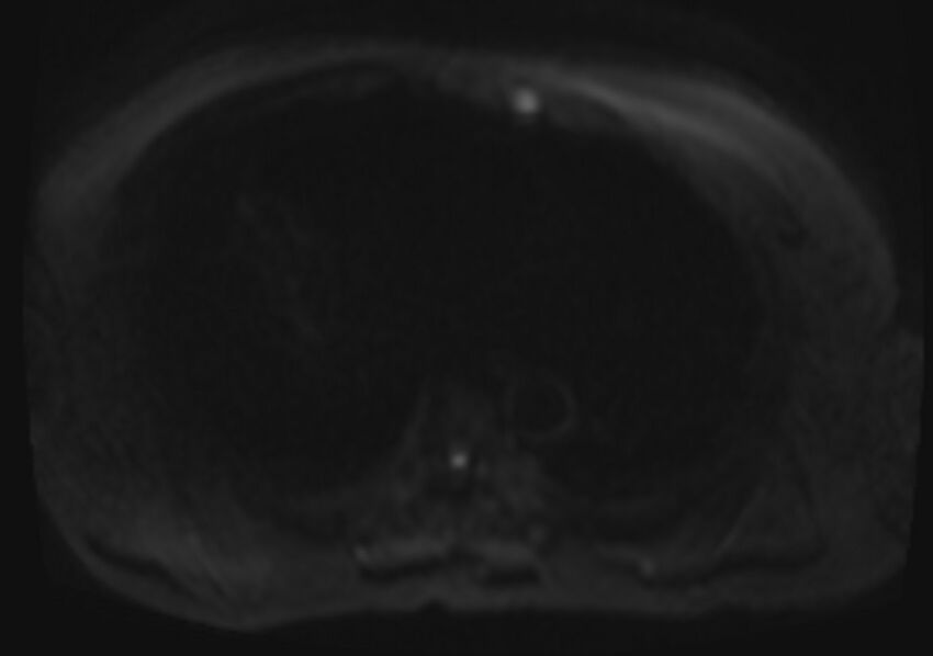 Acute portal vein thrombosis (Radiopaedia 73198-83925 Axial DWI 32).jpg