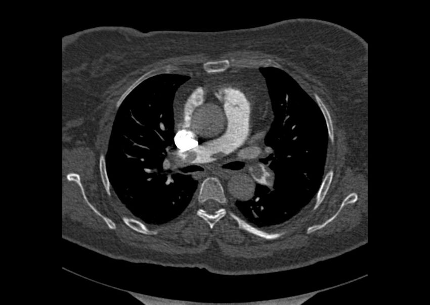 Acute pulmonary embolism (Radiopaedia 29938-30466 Axial C+ CTPA 56).jpg